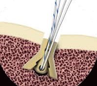 The Morphix Suture Anchor System from Medshape